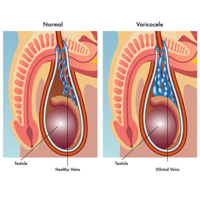 Varicocéle site