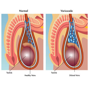 Varicocéle site